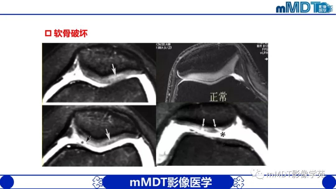 影像PPT - 【PPT】类风湿关节炎的影像诊断-21