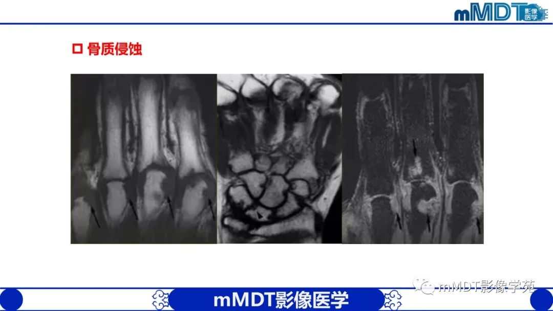 影像PPT - 【PPT】类风湿关节炎的影像诊断-22