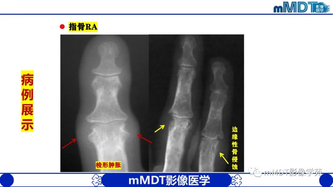 影像PPT - 【PPT】类风湿关节炎的影像诊断-23