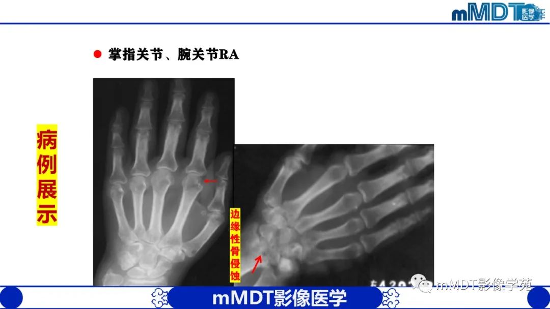 影像PPT - 【PPT】类风湿关节炎的影像诊断-24