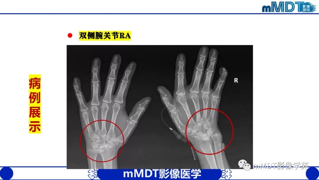 影像PPT - 【PPT】类风湿关节炎的影像诊断-25