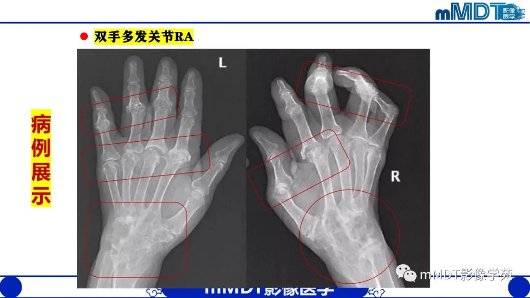 影像PPT - 【PPT】类风湿关节炎的影像诊断-26