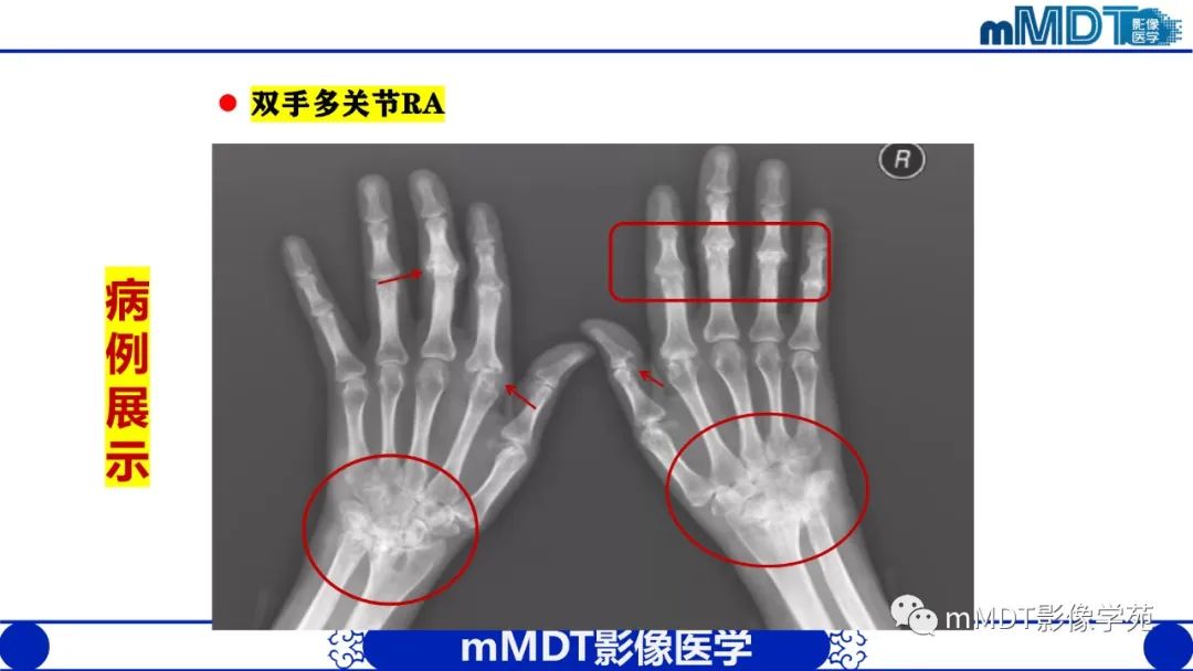 影像PPT - 【PPT】类风湿关节炎的影像诊断-27