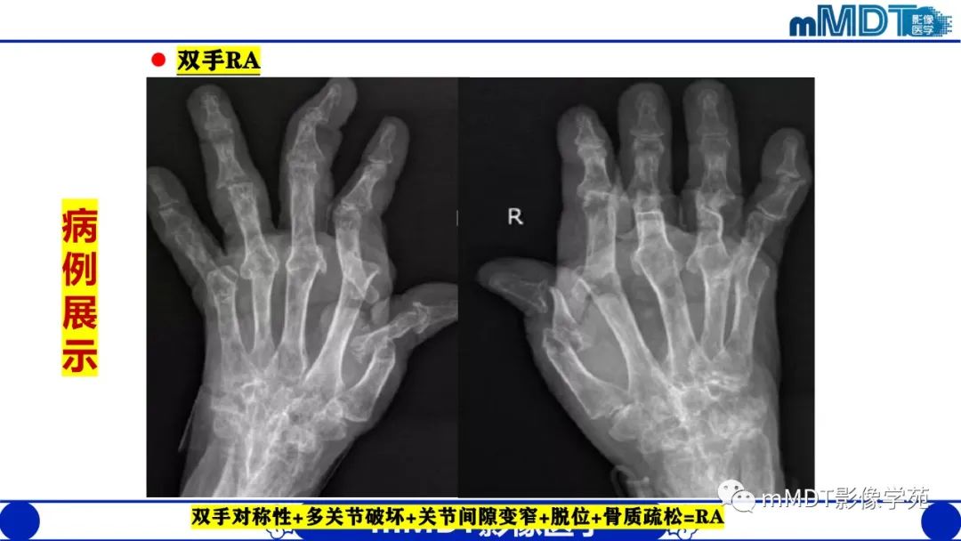 影像PPT - 【PPT】类风湿关节炎的影像诊断-28