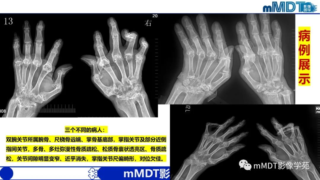 影像PPT - 【PPT】类风湿关节炎的影像诊断-29