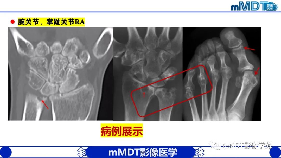 影像PPT - 【PPT】类风湿关节炎的影像诊断-30
