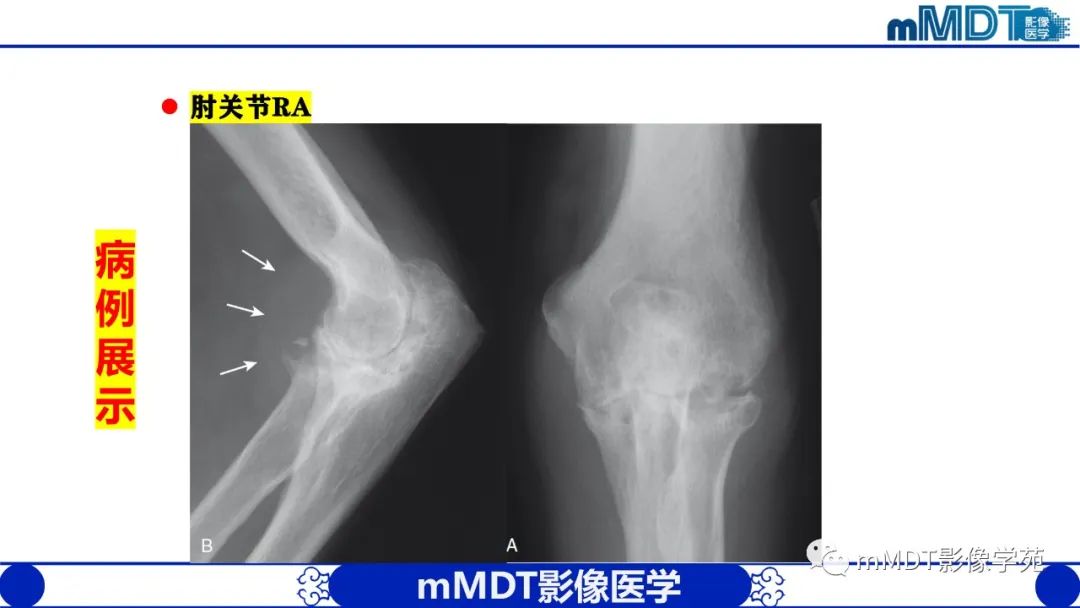 影像PPT - 【PPT】类风湿关节炎的影像诊断-31