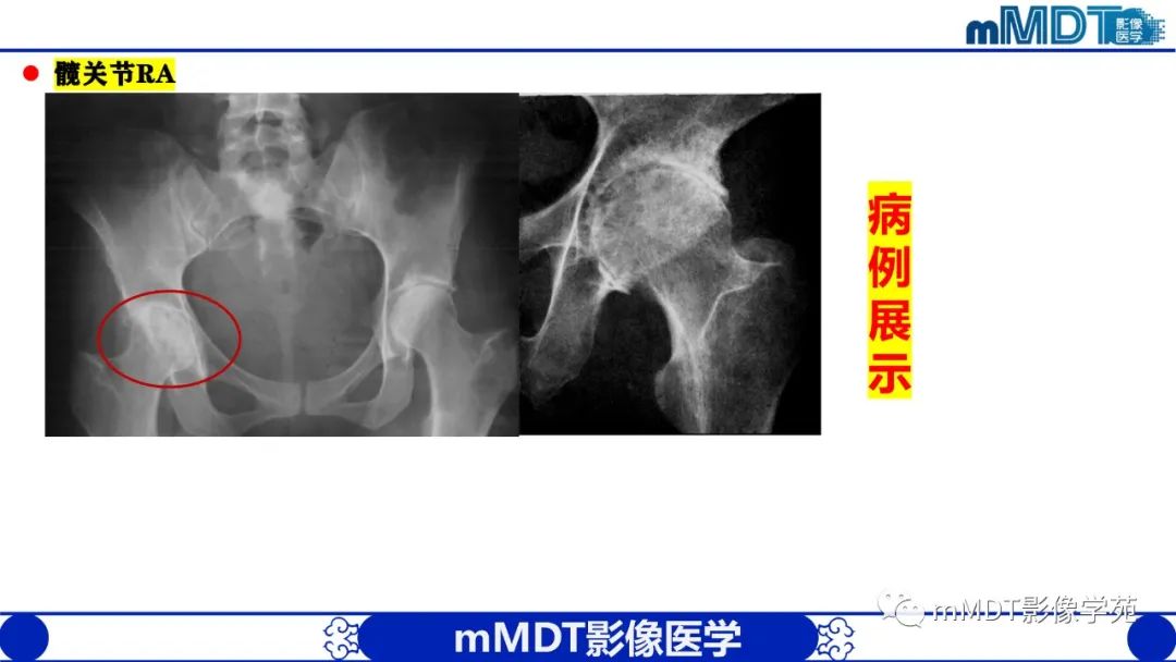 影像PPT - 【PPT】类风湿关节炎的影像诊断-32