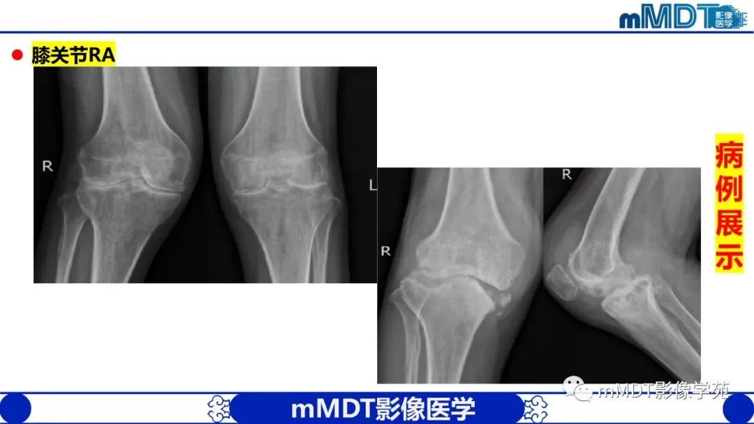 影像PPT - 【PPT】类风湿关节炎的影像诊断-34