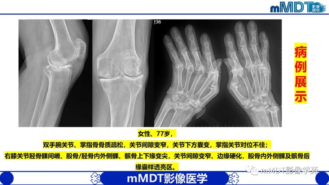 影像PPT - 【PPT】类风湿关节炎的影像诊断-35