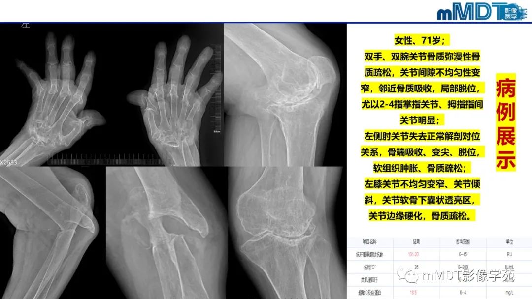 影像PPT - 【PPT】类风湿关节炎的影像诊断-37