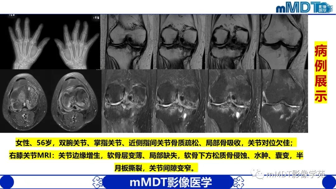 影像PPT - 【PPT】类风湿关节炎的影像诊断-38