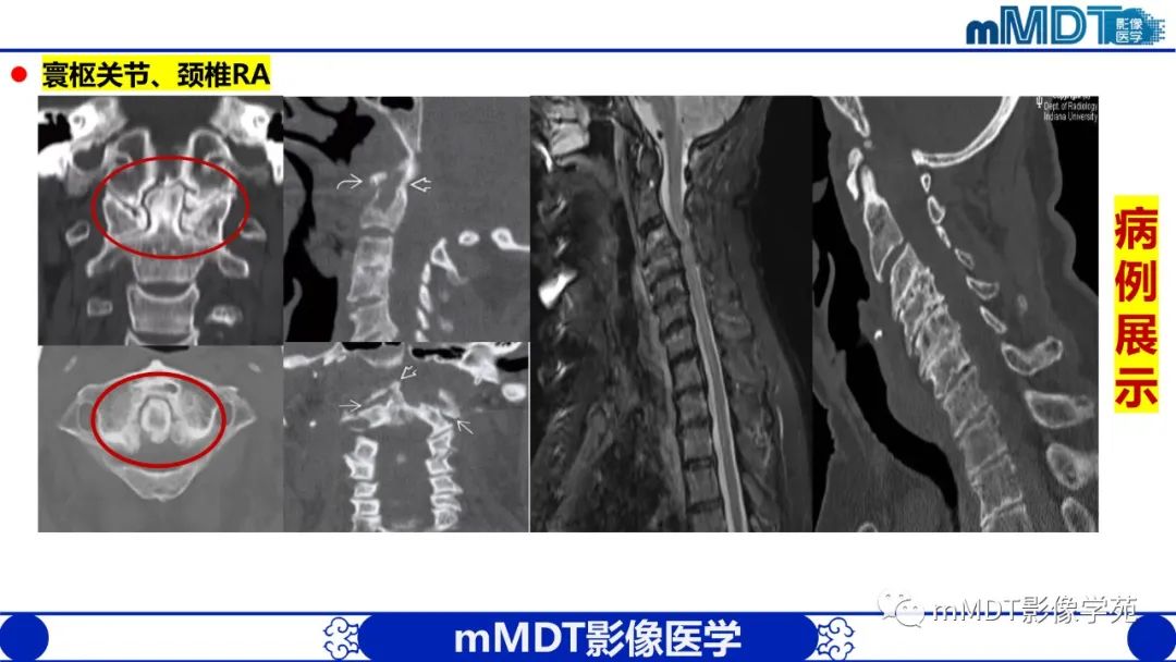 影像PPT - 【PPT】类风湿关节炎的影像诊断-39