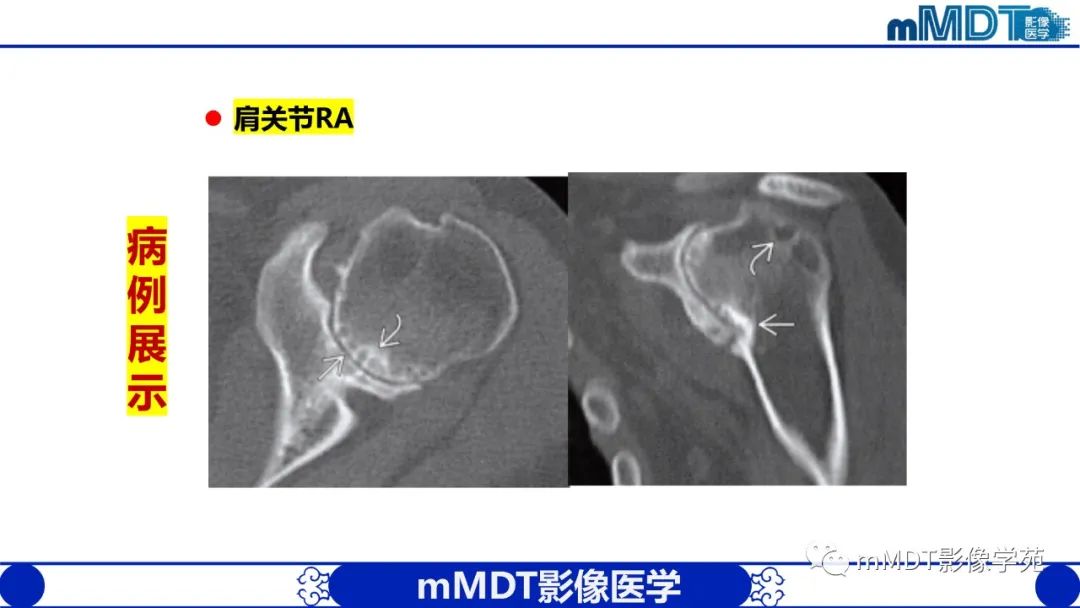 影像PPT - 【PPT】类风湿关节炎的影像诊断-40