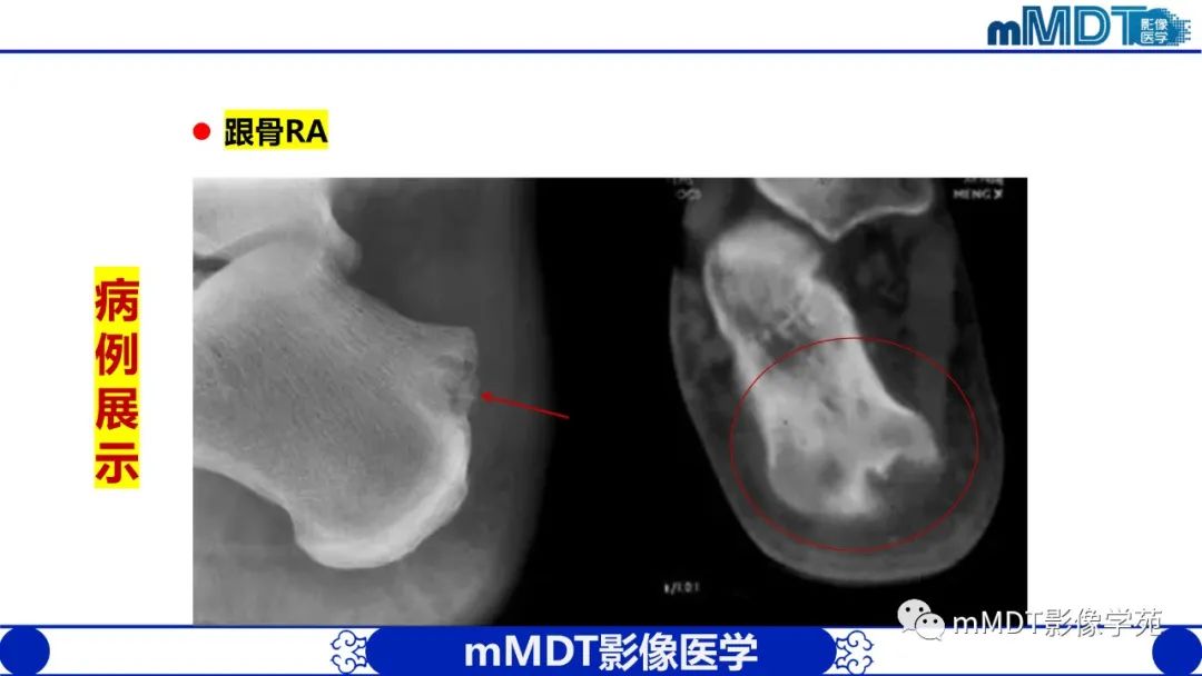 影像PPT - 【PPT】类风湿关节炎的影像诊断-41