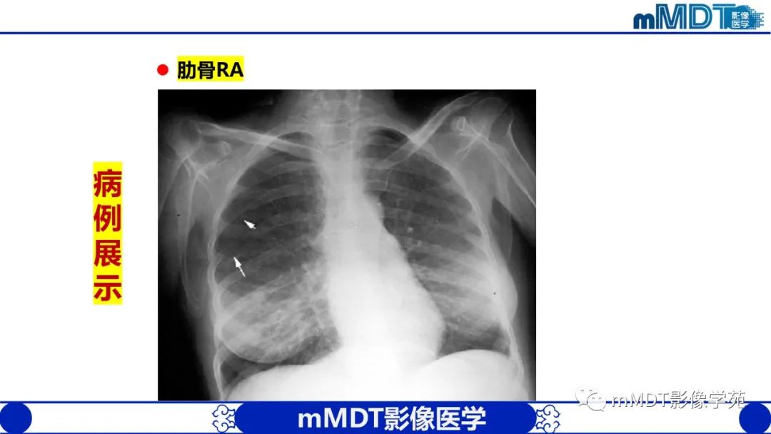 影像PPT - 【PPT】类风湿关节炎的影像诊断-42