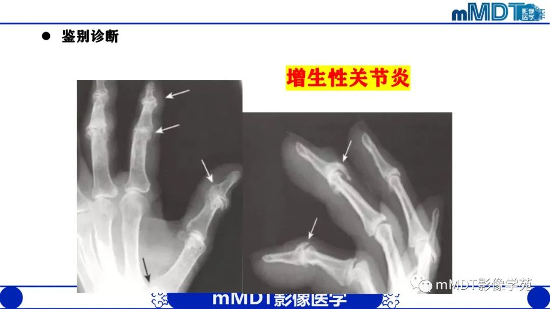 影像PPT - 【PPT】类风湿关节炎的影像诊断-44