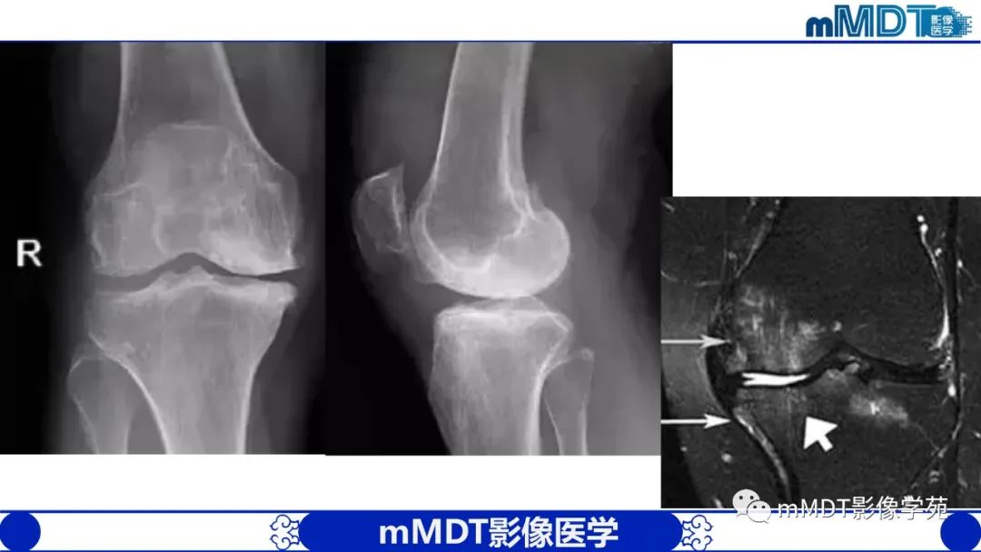影像PPT - 【PPT】类风湿关节炎的影像诊断-45