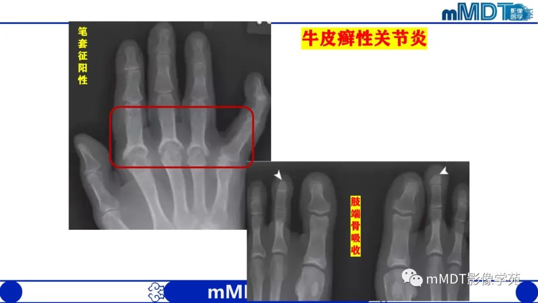影像PPT - 【PPT】类风湿关节炎的影像诊断-46
