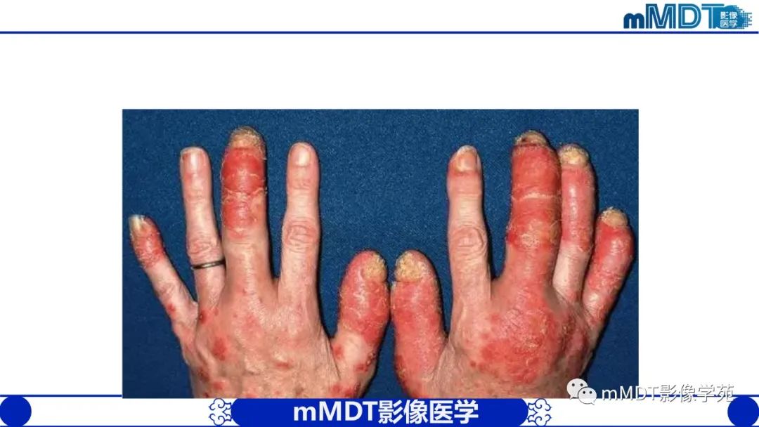 影像PPT - 【PPT】类风湿关节炎的影像诊断-47