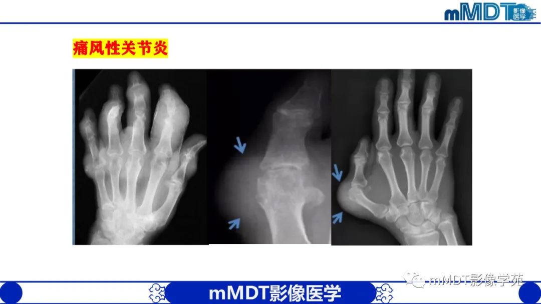 影像PPT - 【PPT】类风湿关节炎的影像诊断-48