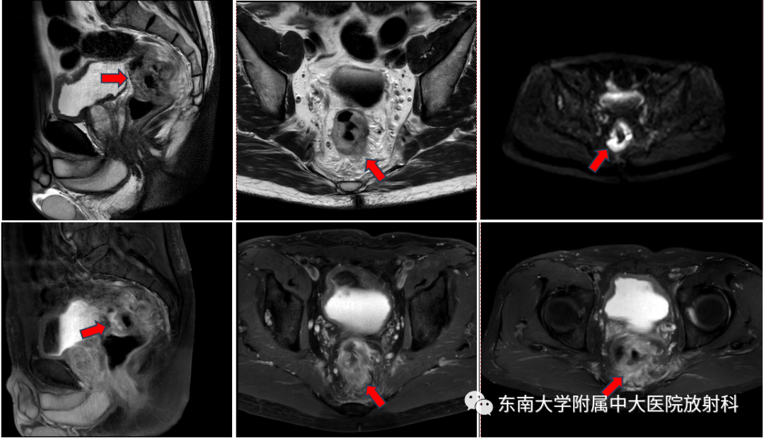 影像PPT - 【PPT】直肠癌影像学诊断与分期-1