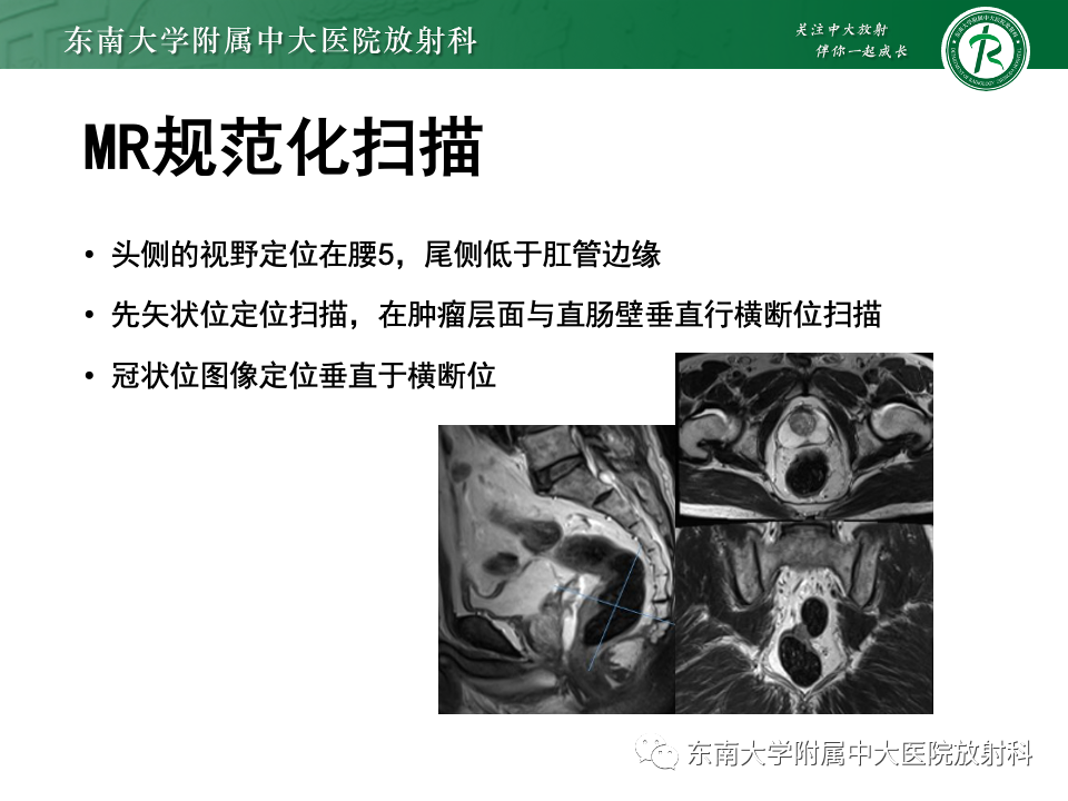 影像PPT - 【PPT】直肠癌影像学诊断与分期-9