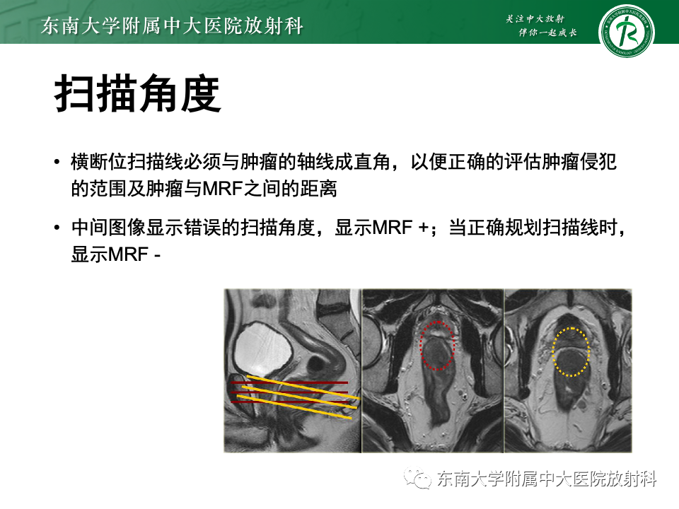 影像PPT - 【PPT】直肠癌影像学诊断与分期-10