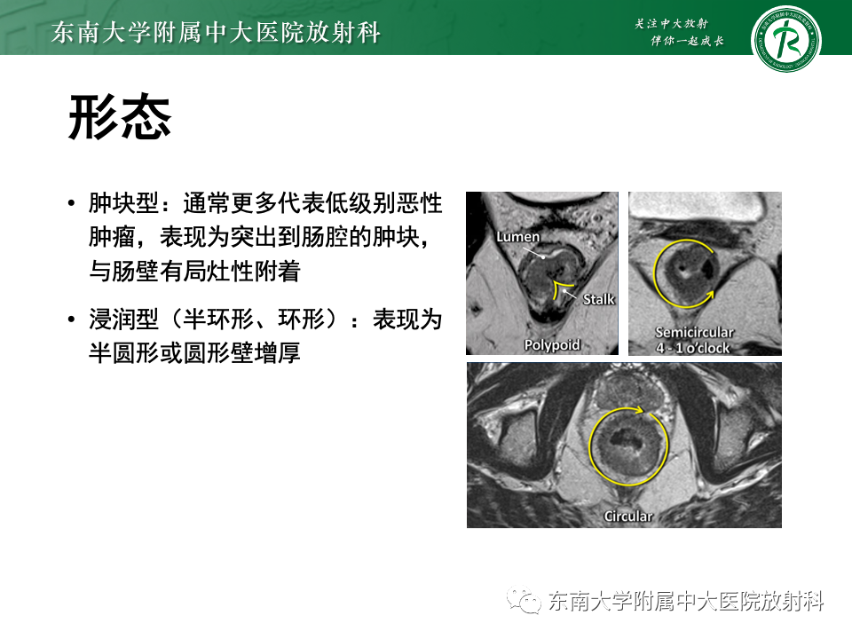 影像PPT - 【PPT】直肠癌影像学诊断与分期-16