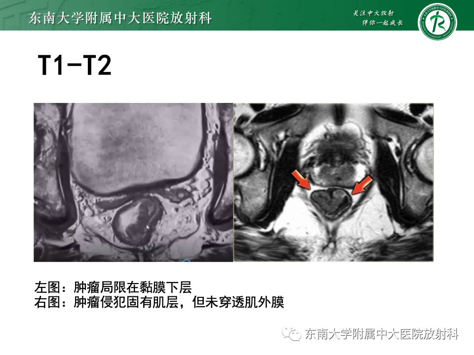 影像PPT - 【PPT】直肠癌影像学诊断与分期-18