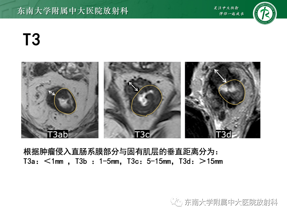 影像PPT - 【PPT】直肠癌影像学诊断与分期-19