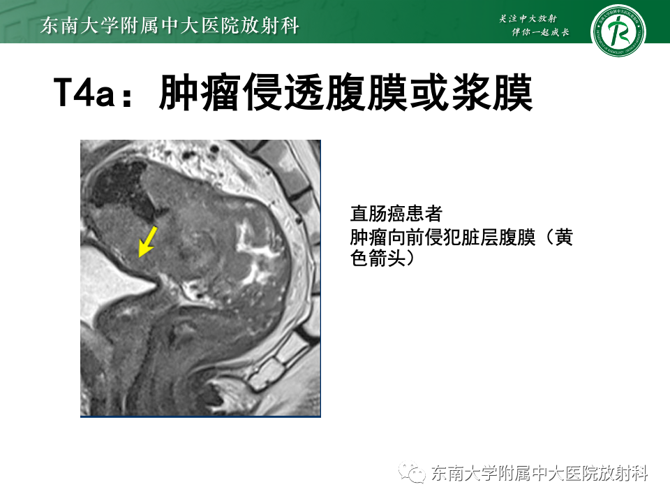 影像PPT - 【PPT】直肠癌影像学诊断与分期-20