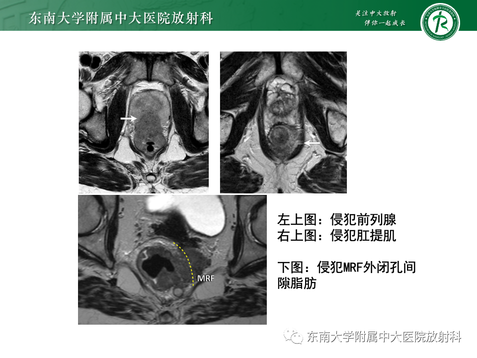 影像PPT - 【PPT】直肠癌影像学诊断与分期-22