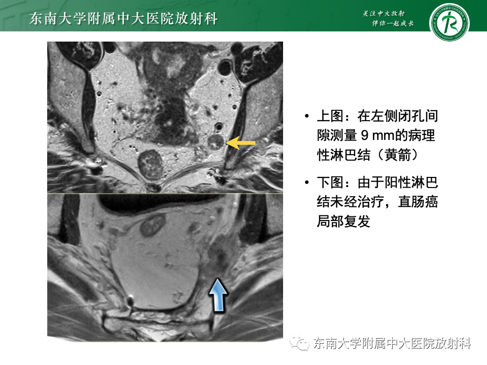 影像PPT - 【PPT】直肠癌影像学诊断与分期-27
