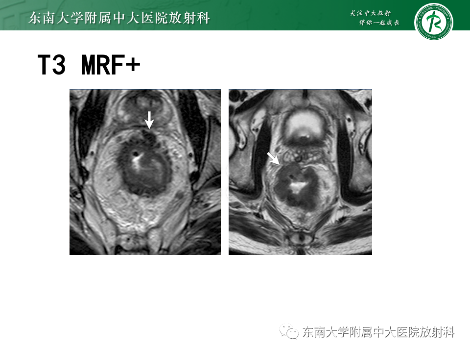 影像PPT - 【PPT】直肠癌影像学诊断与分期-29