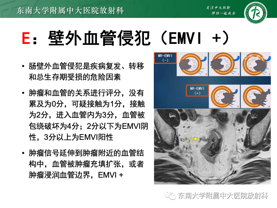 影像PPT - 【PPT】直肠癌影像学诊断与分期-30
