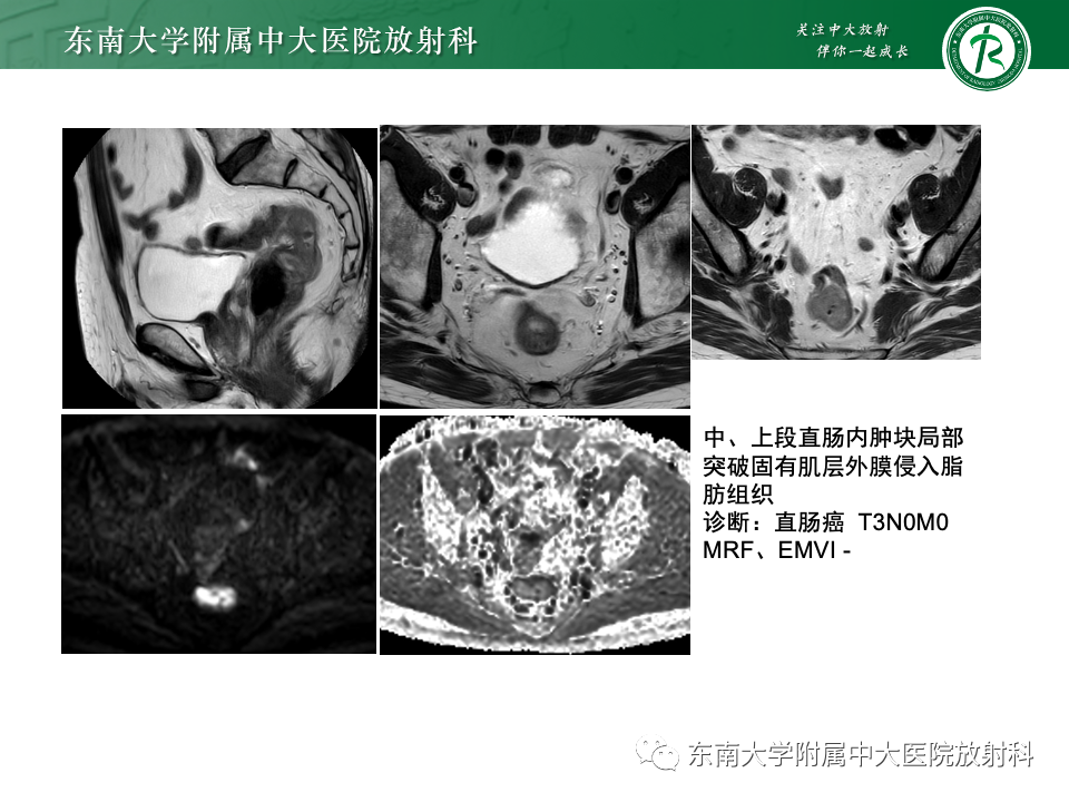 影像PPT - 【PPT】直肠癌影像学诊断与分期-32
