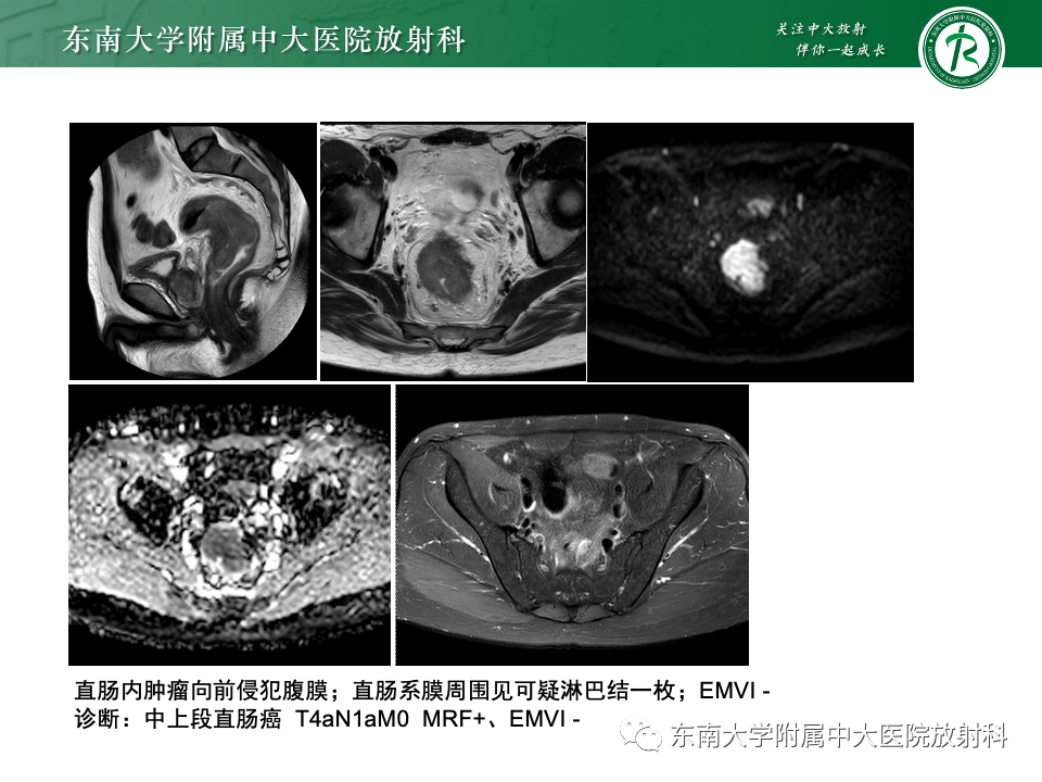 影像PPT - 【PPT】直肠癌影像学诊断与分期-35