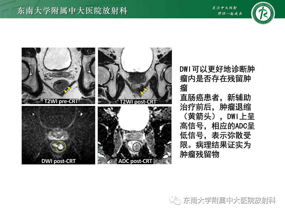 影像PPT - 【PPT】直肠癌影像学诊断与分期-39