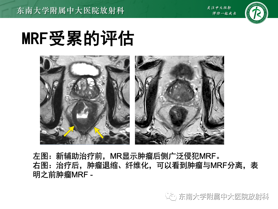 影像PPT - 【PPT】直肠癌影像学诊断与分期-40