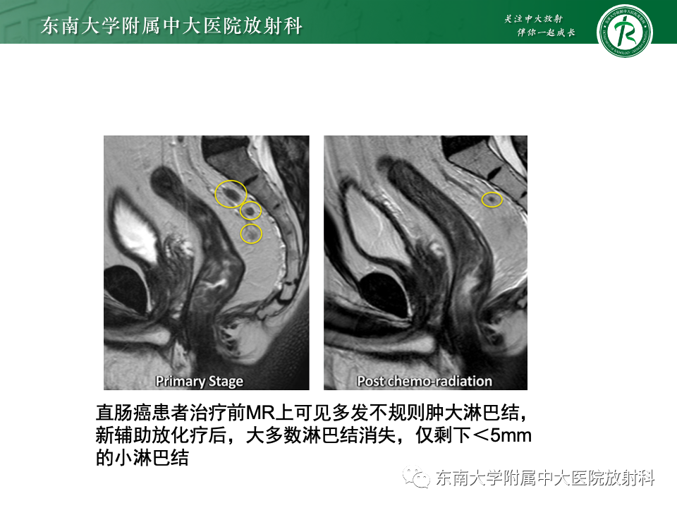 影像PPT - 【PPT】直肠癌影像学诊断与分期-41