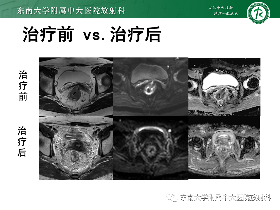 影像PPT - 【PPT】直肠癌影像学诊断与分期-43