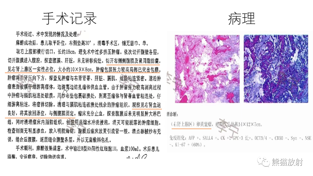影像PPT - 【病例】腹膜后肾上腺区卵黄囊瘤1例CT影像-10