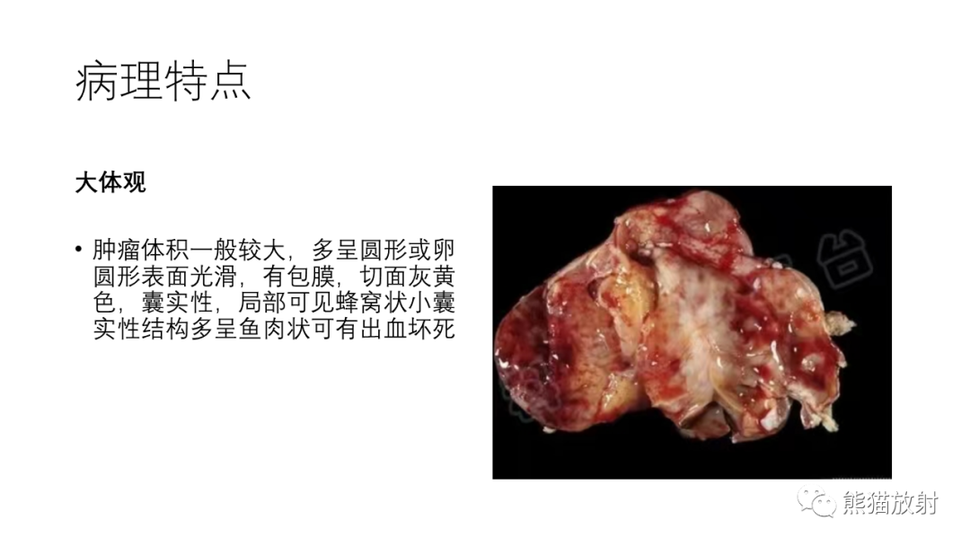 影像PPT - 【病例】腹膜后肾上腺区卵黄囊瘤1例CT影像-12