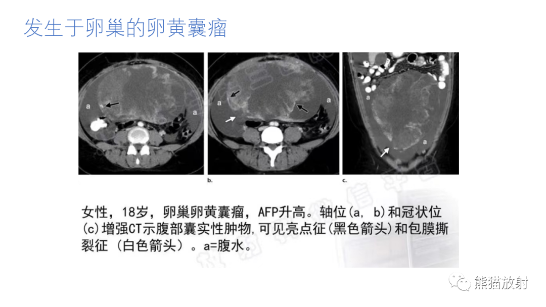 影像PPT - 【病例】腹膜后肾上腺区卵黄囊瘤1例CT影像-17