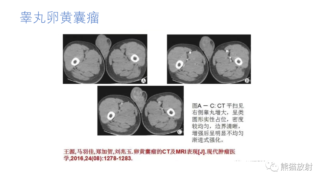 影像PPT - 【病例】腹膜后肾上腺区卵黄囊瘤1例CT影像-19
