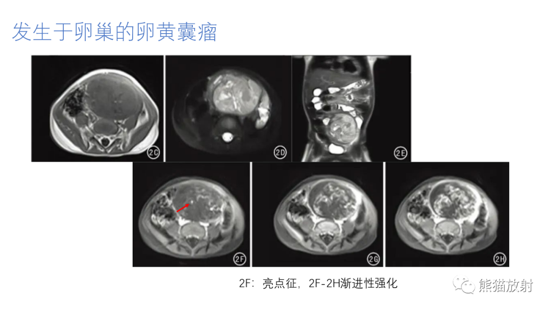 影像PPT - 【病例】腹膜后肾上腺区卵黄囊瘤1例CT影像-18