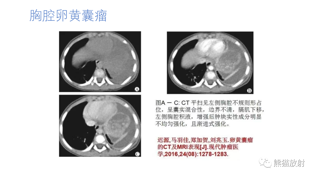影像PPT - 【病例】腹膜后肾上腺区卵黄囊瘤1例CT影像-20