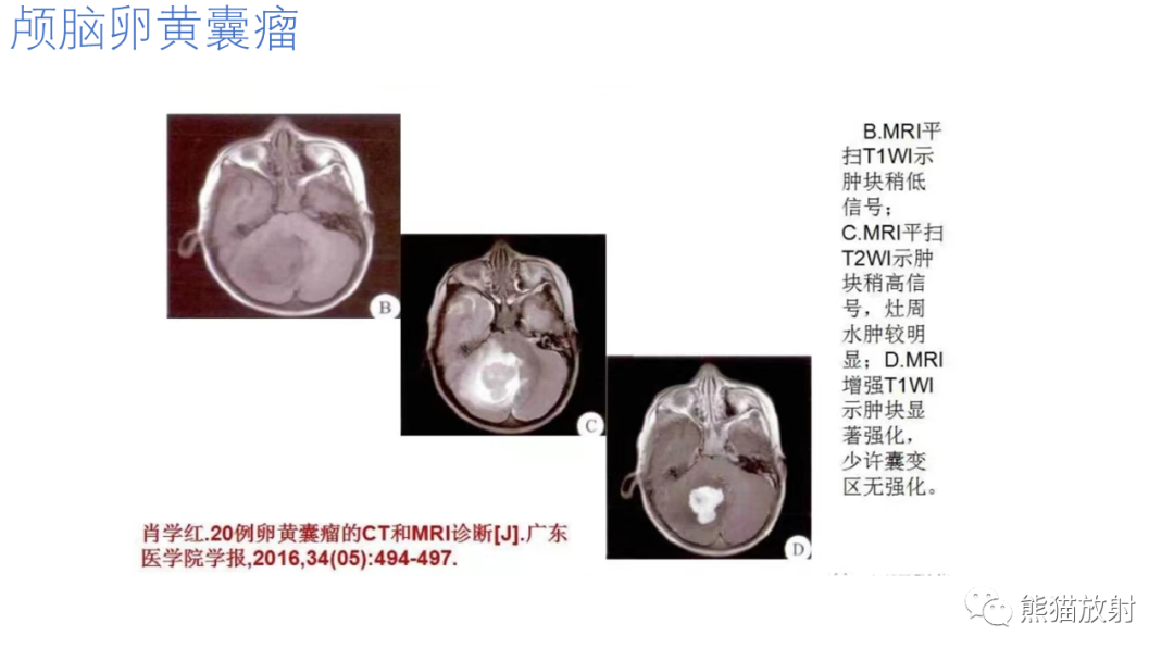 影像PPT - 【病例】腹膜后肾上腺区卵黄囊瘤1例CT影像-21