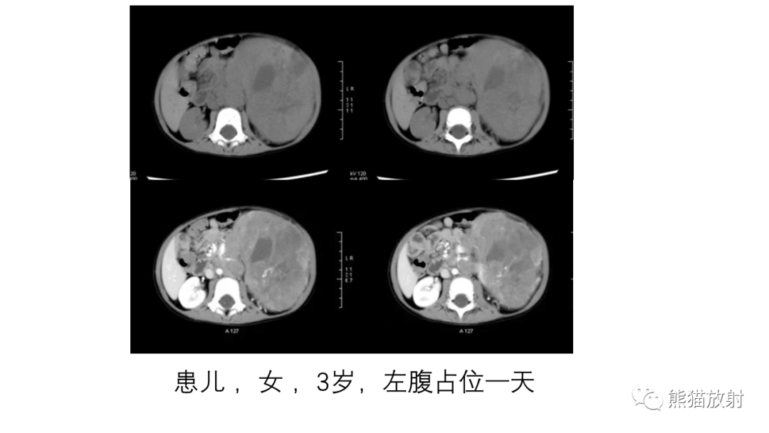 影像PPT - 【病例】腹膜后肾上腺区卵黄囊瘤1例CT影像-26
